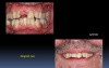 Clinical Case Of Implants