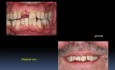 Clinical Case Of Implants