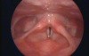 Nodules On The Vocal Folds