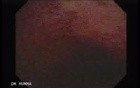 Colitis Ulcerosa - Pseudopolyps (19 of 22)