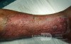 Atrophic Lower Leg Ulceration- Stage IV