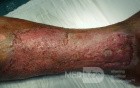 Atrophic Lower Leg Ulceration- Stage IV