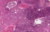 Bronchopneumonia With Micro-Abscesses