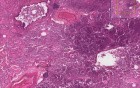 Bronchopneumonia With Micro-Abscesses