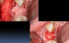 Socket Grafting 101 Part B