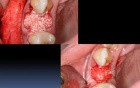 Socket Grafting 101 Part B