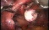 Myoma And Broad Ligament Laparoscopic Treatment