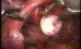 Myoma And Broad Ligament Laparoscopic Treatment