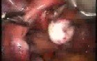 Myoma And Broad Ligament Laparoscopic Treatment
