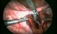 Isolation And Ligation Of Uterine Arteries At Its Origin