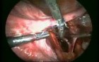 Isolation And Ligation Of Uterine Arteries At Its Origin