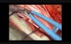 Spinal Cord Tumor - Intra Dural Neurofibroma  - Microsurgical Excision