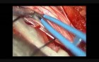 Spinal Cord Tumor - Intra Dural Neurofibroma  - Microsurgical Excision