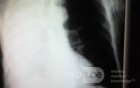 Chest X-ray PA View 