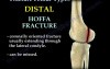 Fracture Femur Types 