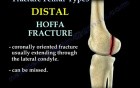 Fracture Femur Types 