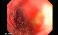 Consecutive colonoscopy with dilation was carried out (10 of 15)