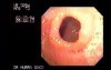 Gastric Antral Band