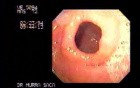 Gastric Antral Band