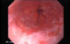 Barrett's Esophagus of long segment (10 of 11)