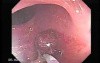 Endoscopic Appearance of Pedicled Polyp of the Descending Colon (6 of 7)