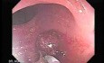 Endoscopic Appearance of Pedicled Polyp of the Descending Colon (6 of 7)