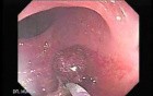 Endoscopic Appearance of Pedicled Polyp of the Descending Colon (6 of 7)