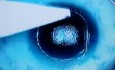 Myopia Surgery - Lasik Enhancement After 10 Years