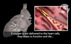Myocardial Infarction with Hemopericardial Tamponade