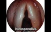 Vocal Folds Nodules - Microsurgery
