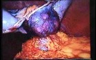 Jejunal Gastrointestinal Stromal tumor (GIST) (84 of 86)