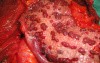 Multiple Rectal Ulcers (84 of 110)