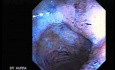 Endoscopy Of Ulcerative Colitis (3 of 3)