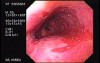 Barrett's Esophagus of long segment (1 of 24)