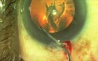 Plasma Ablation Capsulotomy - Fugo Blade Or Femtosecond Laser?
