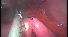 Gastrojejunostomy - SILS 