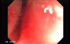 Colitis Ulcerosa - Pseudopolyps (17 of 22)