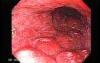 Scirrhous Gastric Carcinoma - Endoscopy (1 of 15)