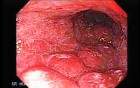 Scirrhous Gastric Carcinoma - Endoscopy (1 of 15)