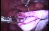 Laparoscopic Treatment Of Big Ovarian Endometriosis Cyst