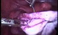 Laparoscopic Treatment Of Big Ovarian Endometriosis Cyst