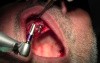 Osteotomy Preps - Implant Surgery, #5-6-7 Sites