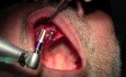 Osteotomy Preps - Implant Surgery, #5-6-7 Sites