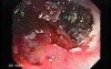 Tubulo - Villous Rectal Adenoma - Endoscopy (18 of 35)