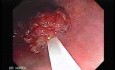 Endoscopic Resection of Giant Tubulo-Villous of the rectum (9 of 35)