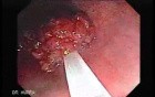 Endoscopic Resection of Giant Tubulo-Villous of the rectum (9 of 35)
