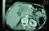 Gastric Ulcer with Gastrocolic fistula due to a Zollinger-
 Ellison Syndrome (22 of 33)