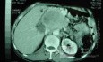 Gastric Ulcer with Gastrocolic fistula due to a Zollinger-
 Ellison Syndrome (22 of 33)