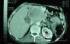 Gastric Ulcer with Gastrocolic fistula due to a Zollinger-
 Ellison Syndrome (22 of 33)