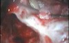Cholesteatoma - Canal Up Mastoidectomy Incision - Part 2 - Grafting, Ossiculoplasty